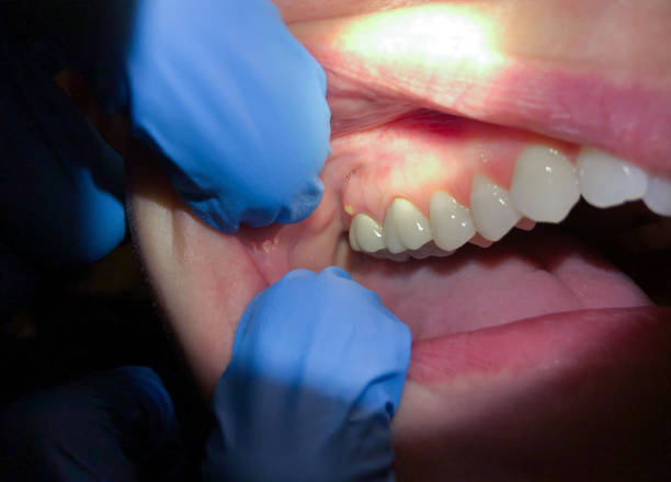 Best Emergency Gum Treatment in Maitland, FL